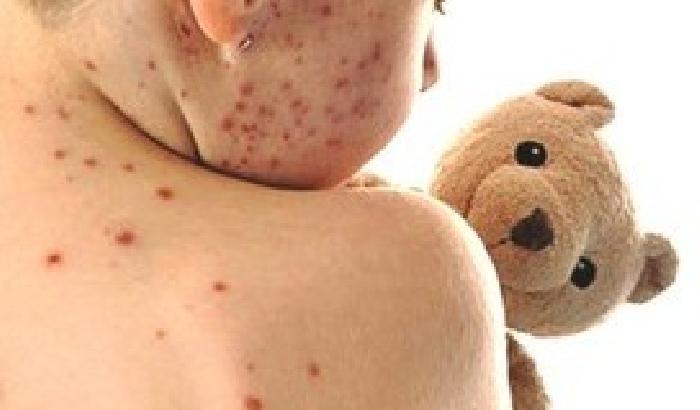 Nel 2013 il morbillo ha fatto più morti dell’Aids