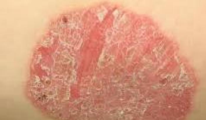 2,5 milioni di italiani soffrono di Psoriasi