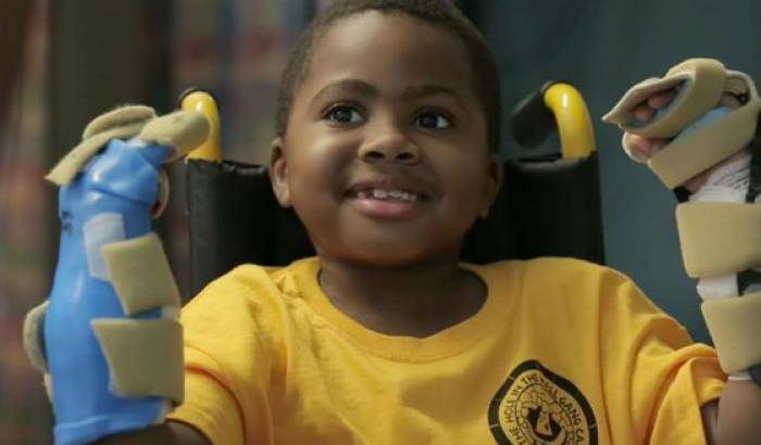 0004A130-zion-harvey-il-primo-bambino-su-cui-i-medici-hanno-eseguito-un-doppio-trampianto-alle-mani Zion Harvey, il primo bambino su cui i medici hanno eseguito un doppio trampianto alle mani