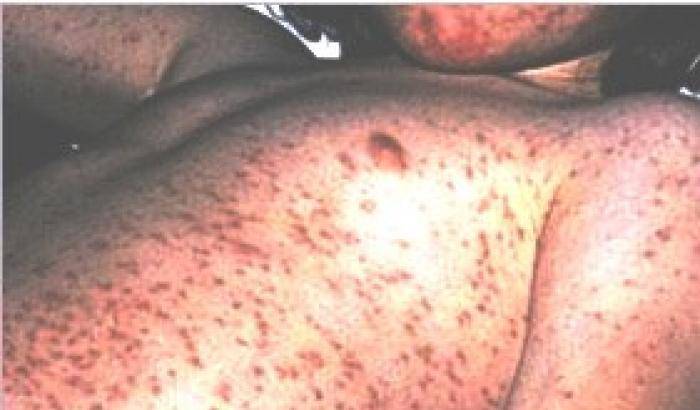 0004D514-morbillo Morbillo