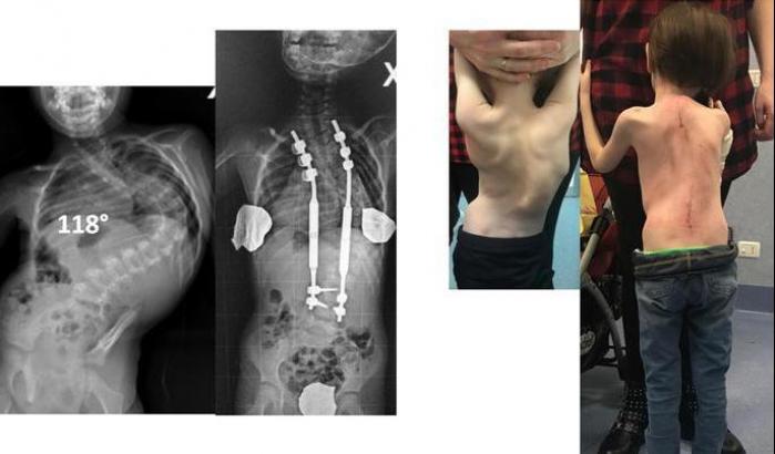 Una bimba con una rara scoliosi è guarita con le barre magnetiche