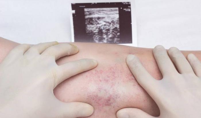 Vaccino Johnson & Johnson e i casi sospetti di trombosi: ecco cosa dicono i nostri virologi