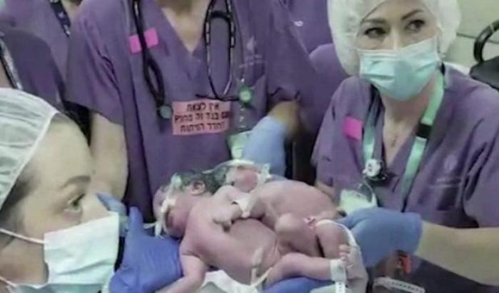 Il bellissimo sguardo di due gemelline siamesi divise dopo un intervento di 12 ore
