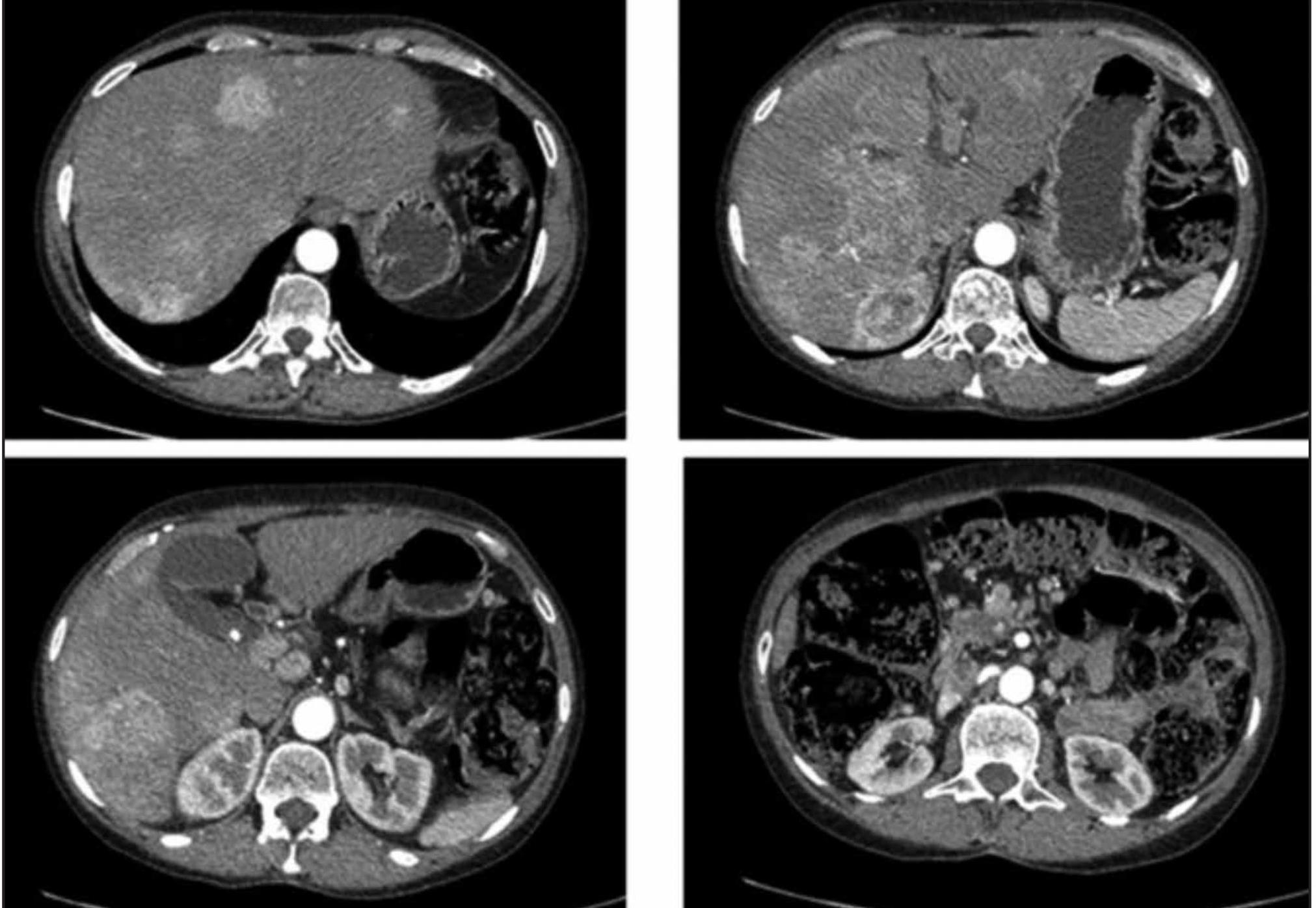 Oncologia: cosa sono i tumori neuroendocrini e quali organi colpiscono