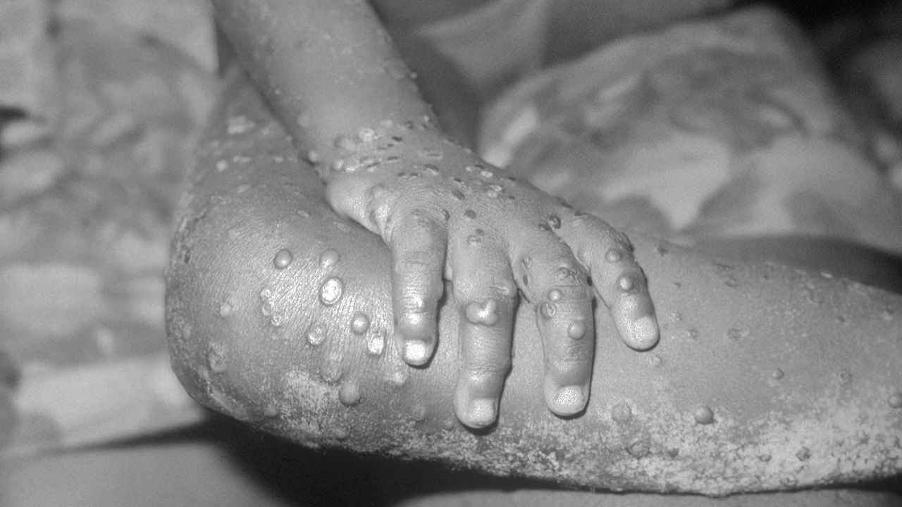 Gli Stati Uniti hanno dichiarato il vaiolo delle scimmie un'urgenza sanitaria