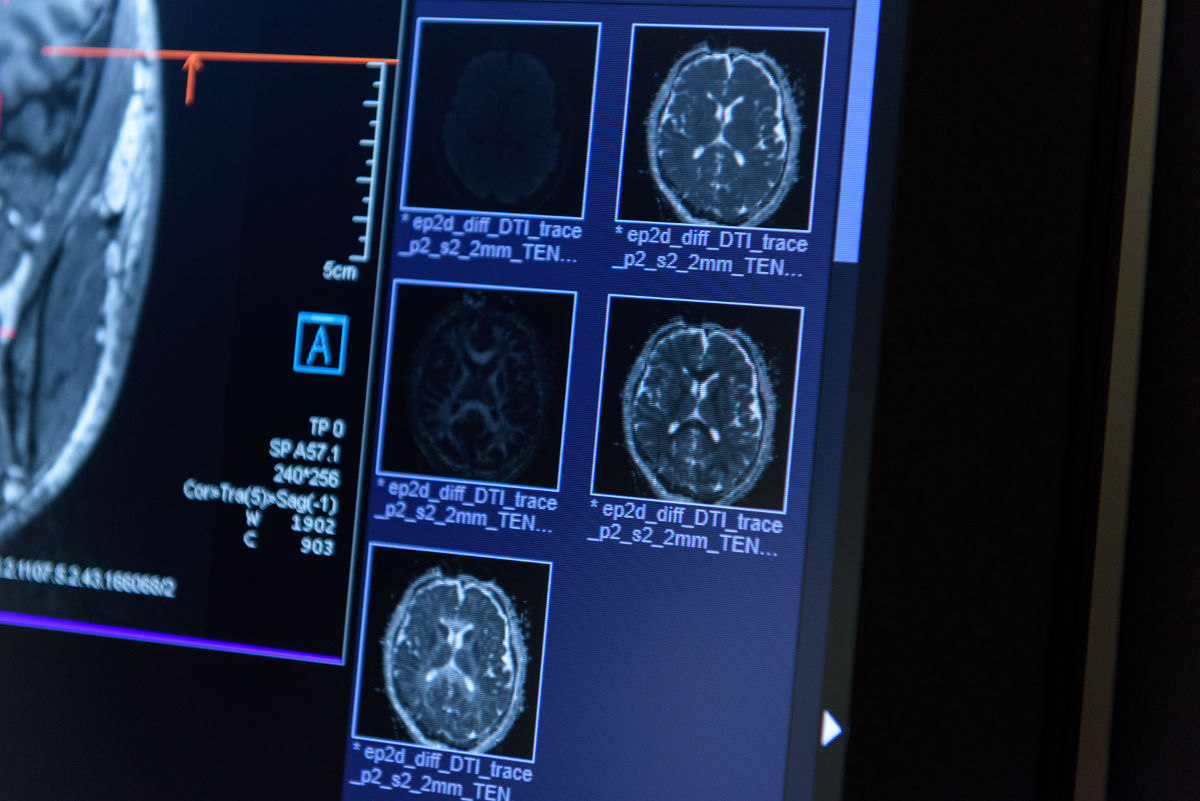 Le cellule staminali del cervello riducono gli effetti della sclerosi: ecco i risultati dello studio