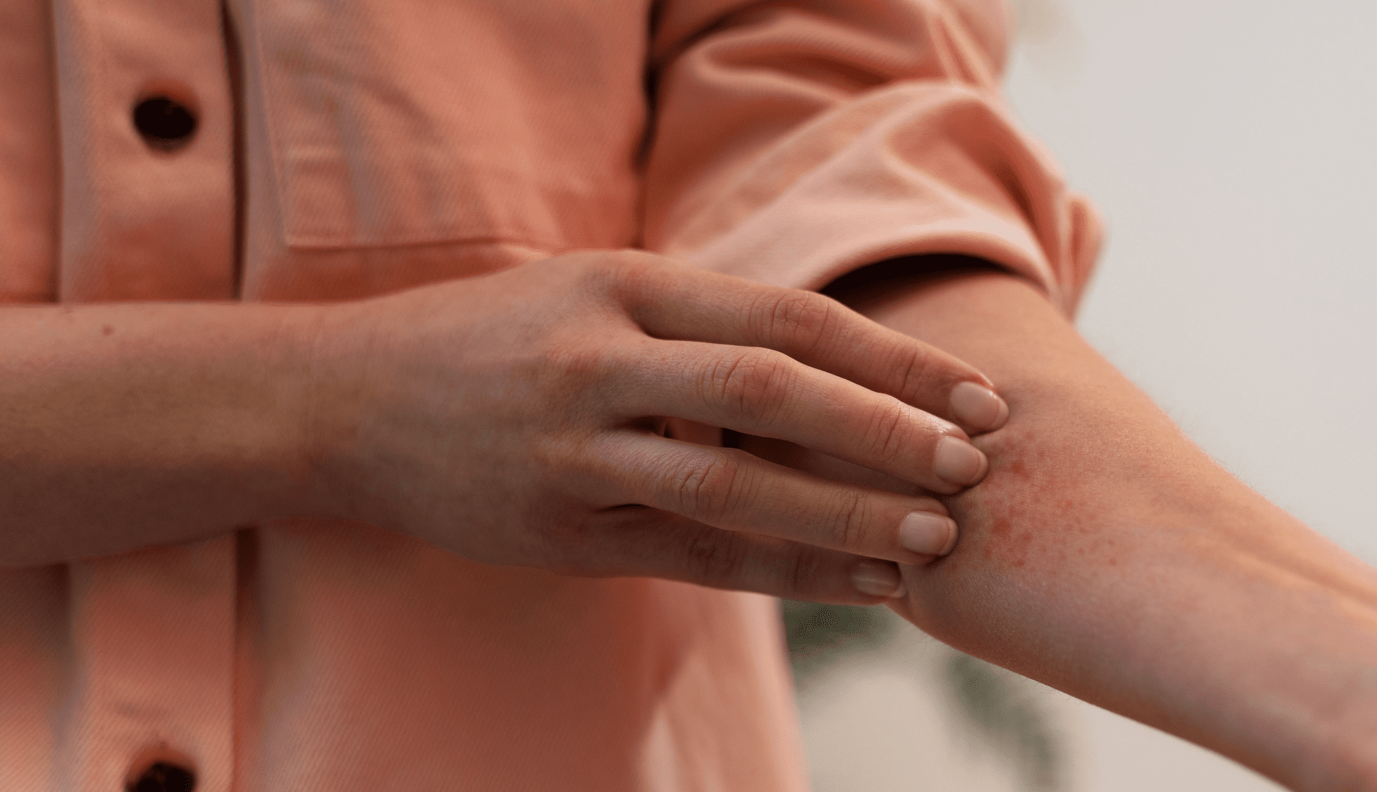 Si può prendere il sole con la dermatite atopica?