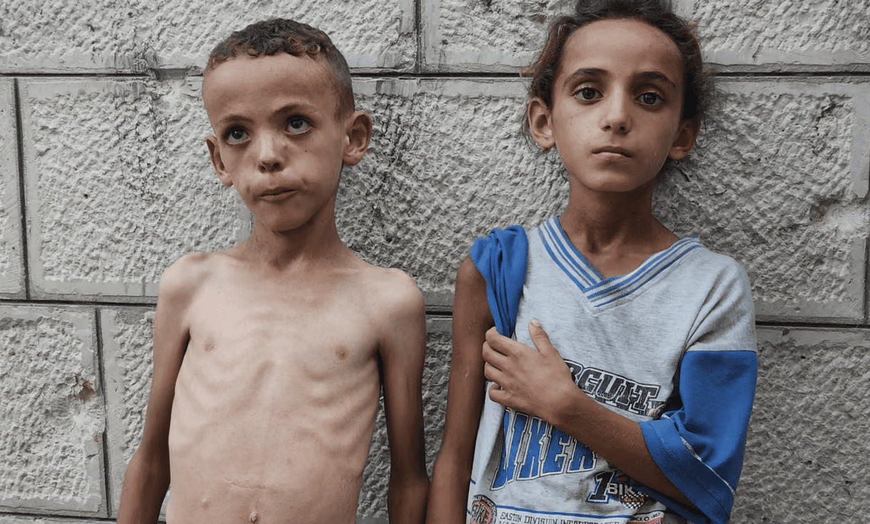 Il bambino “Smiley” che muore di fame a Gaza: la carestia è ormai realtà