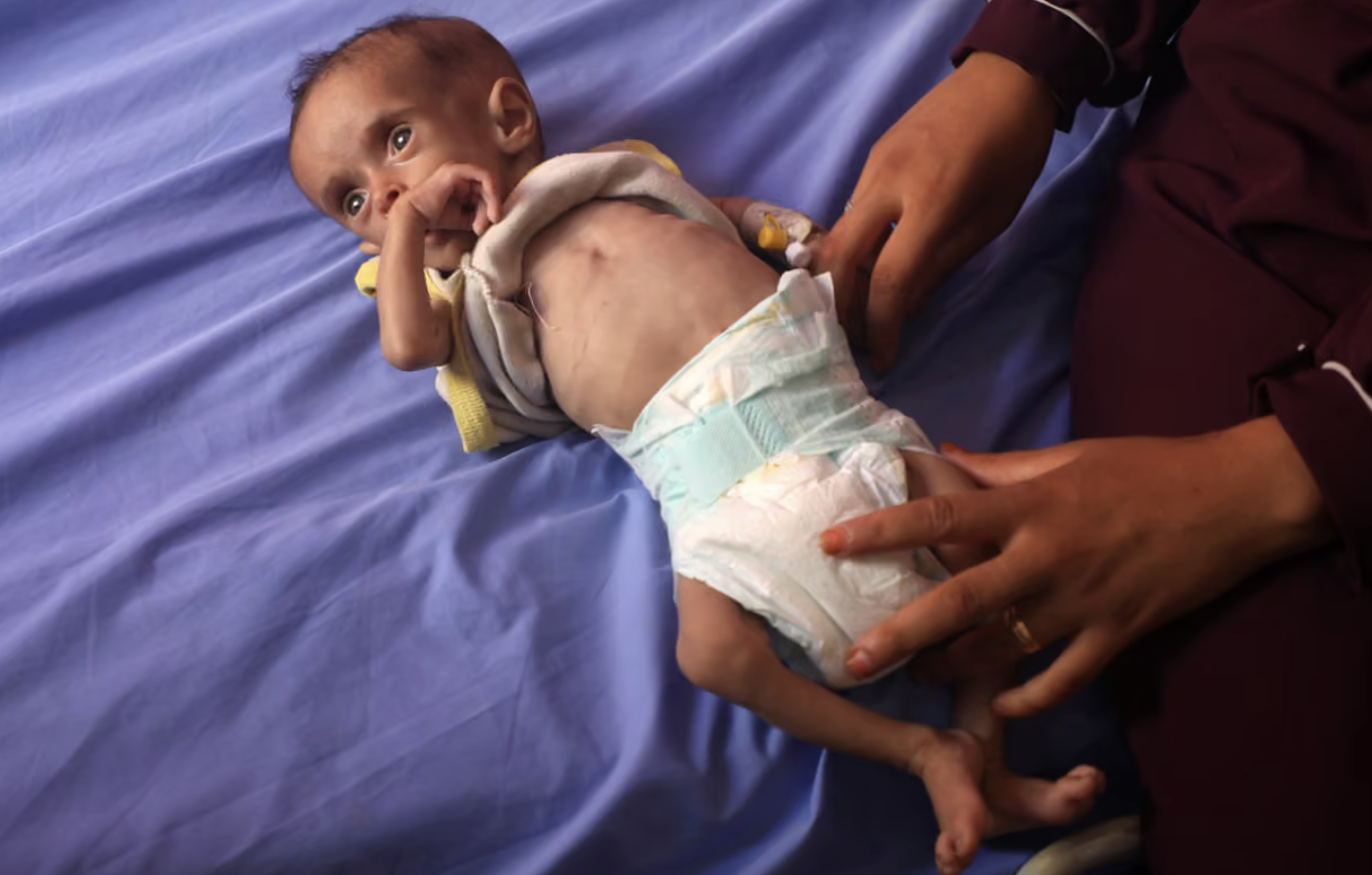 Gaza sta esaurendo gli alimenti terapeutici per salvare i bambini malnutriti: allarme delle agenzie Onu