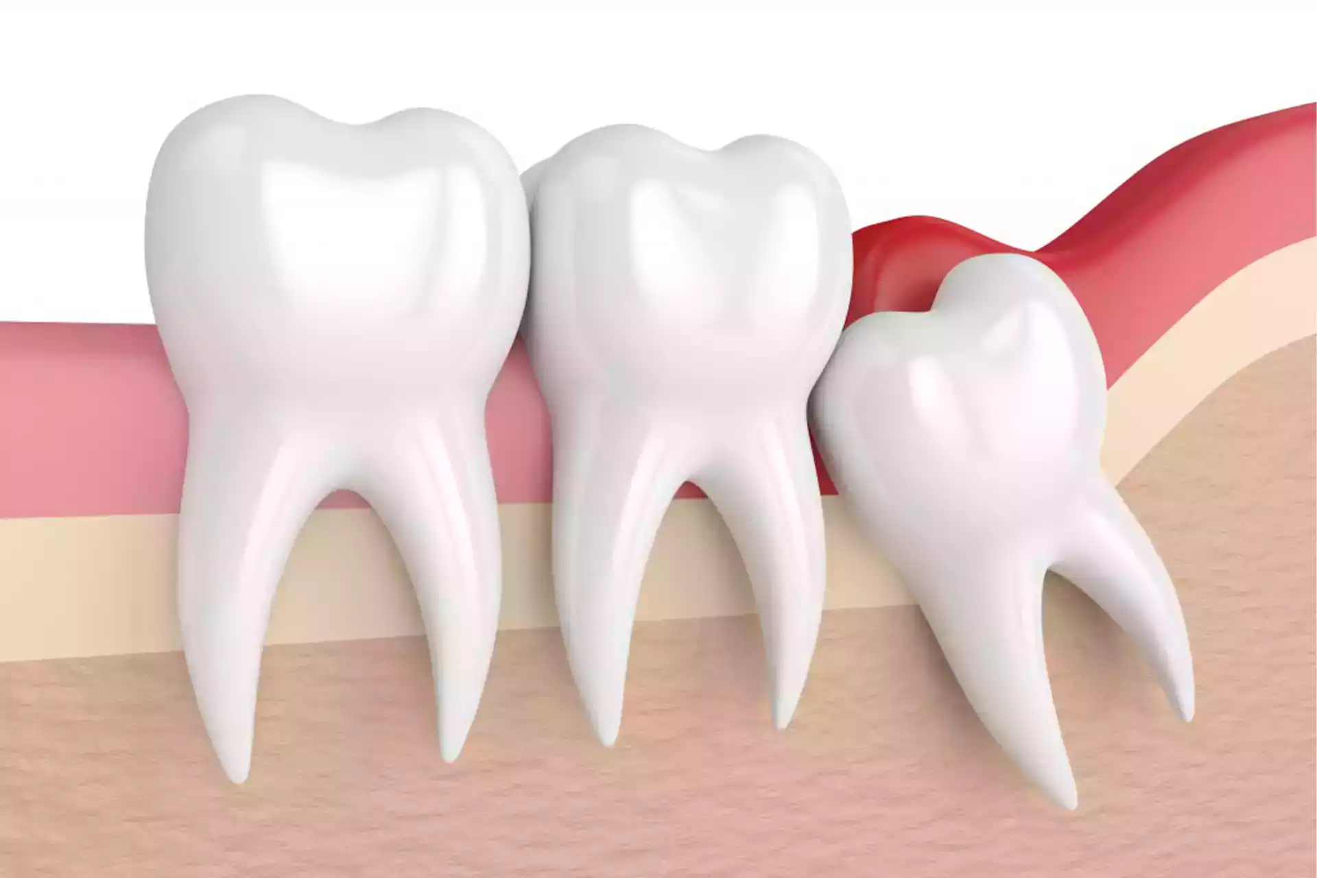 Denti del giudizio: quando è davvero necessaria l'estrazione?